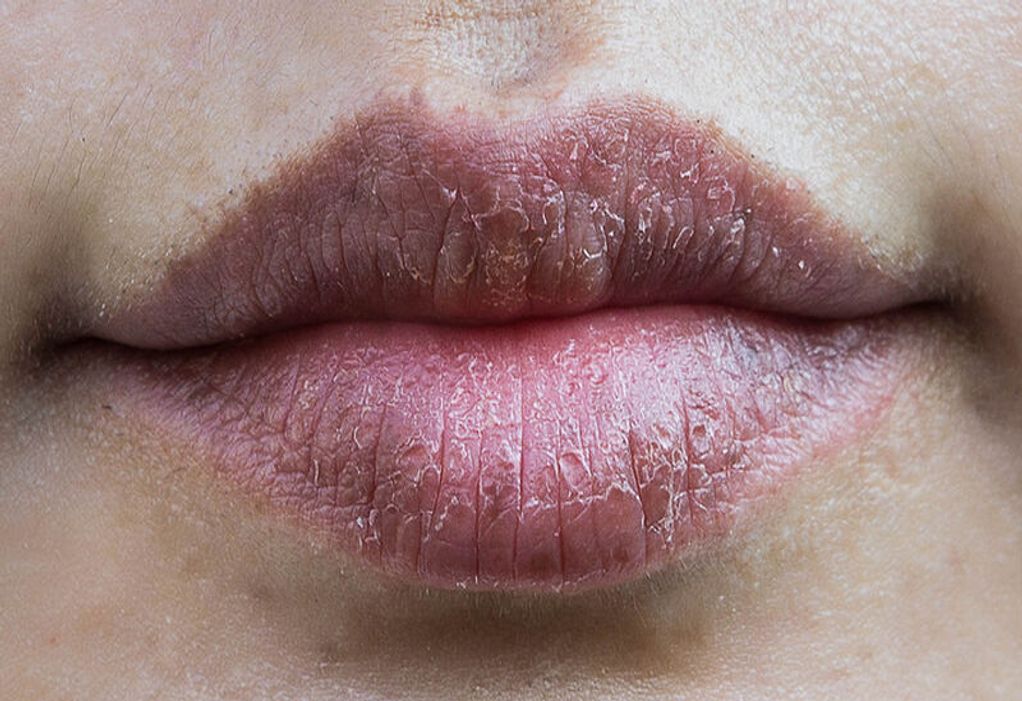 Εννιά συμβουλές για τα σκασμένα χείλη