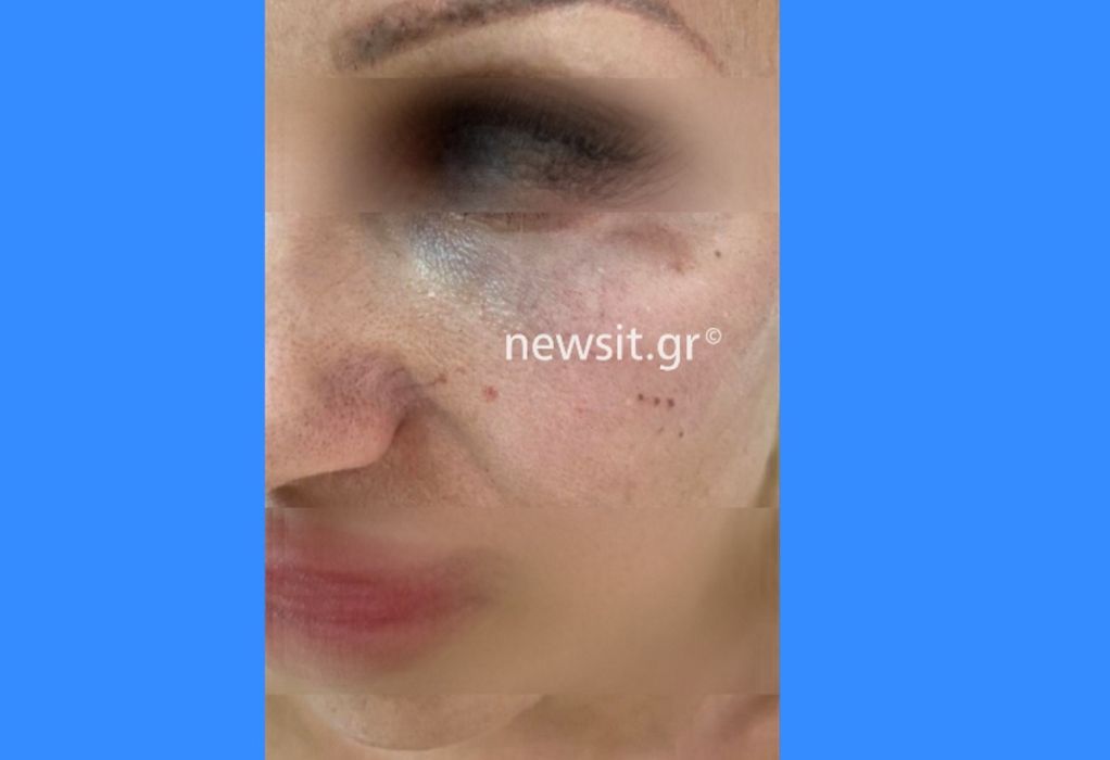 Θέμης Αδαμαντίδης: Φωτογραφία με τα χτυπήματα στο πρόσωπο της πρώην συντρόφου του
